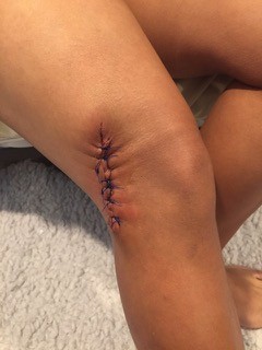puckered stitched on leg